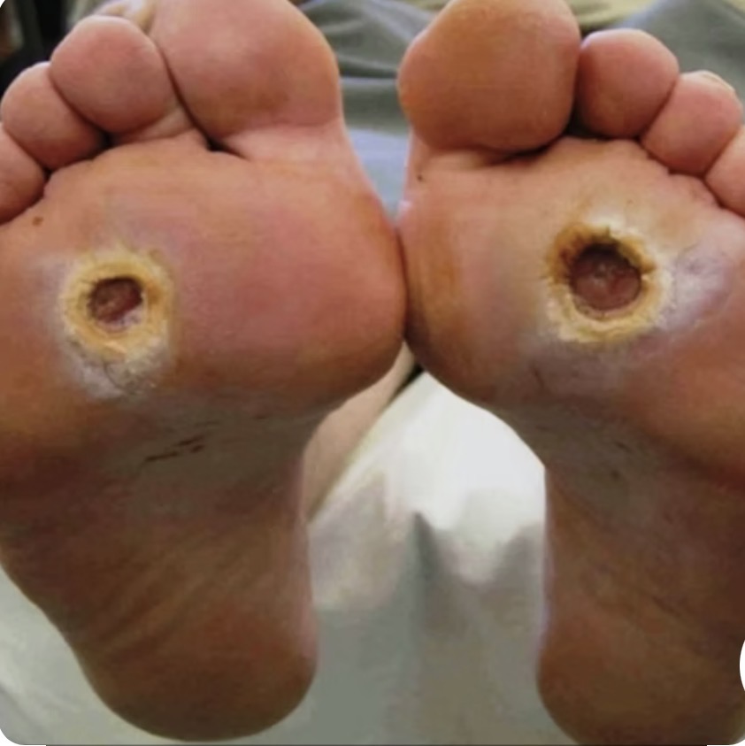 Diabetic foot care