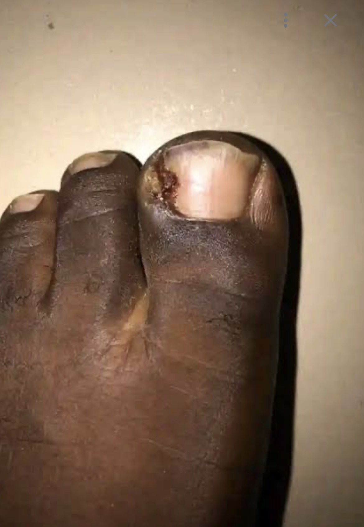 Ingrown toenails