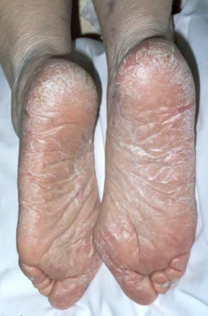 Nail and skin conditions
