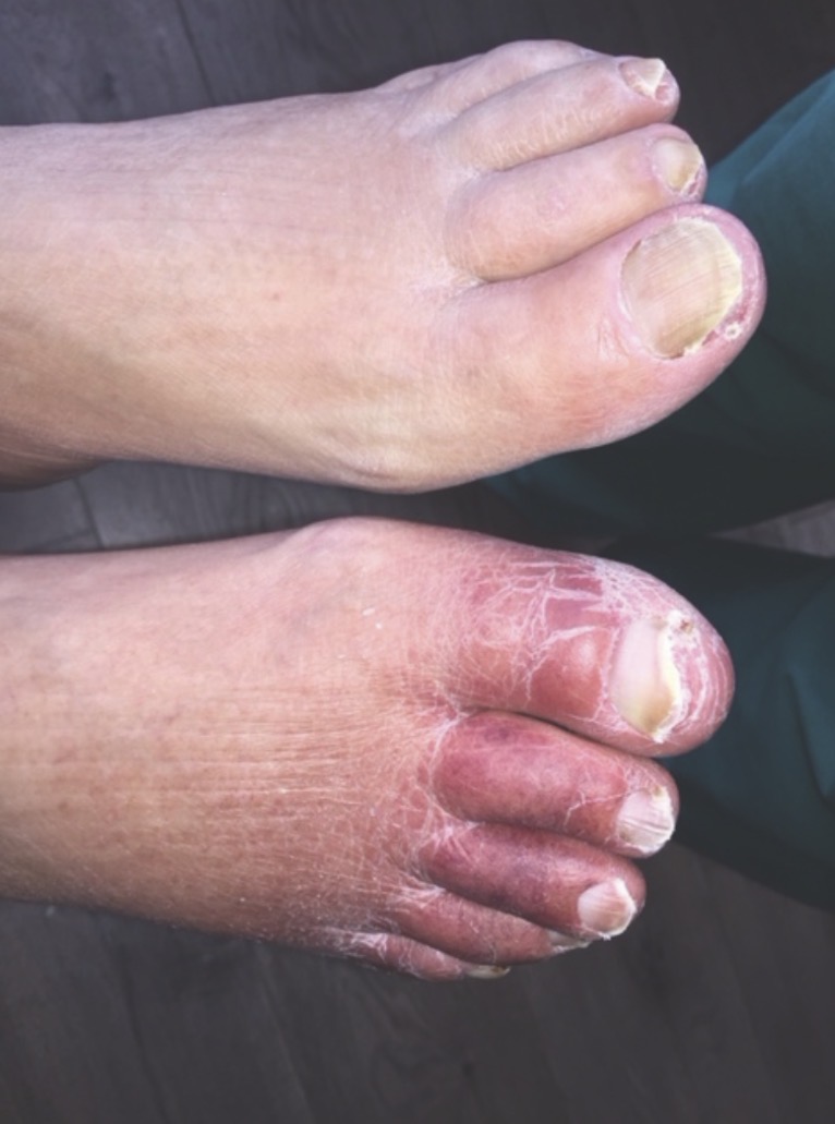 Renal patient foot care